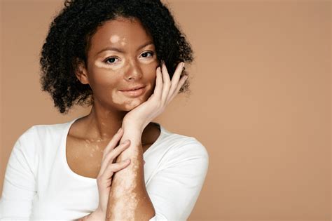 vitiligo fotos|8,486 Vitiligo Stock Photos & High